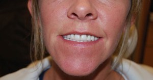 Dental Implants With Nizar Merheb MD