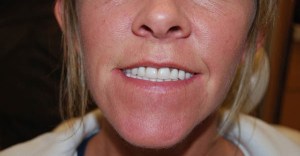 Dental Implants With Nizar Merheb MD