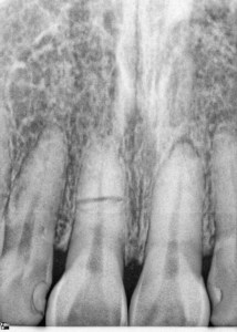 Dental Implants With Nizar Merheb MD