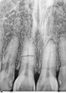 Dental Implants With Nizar Merheb MD