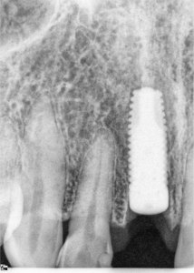 Dental Implants With Nizar Merheb MD