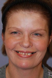 Dental Implants With Nizar Merheb MD