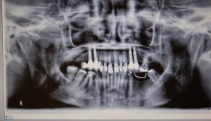 Dental Implants With Nizar Merheb MD