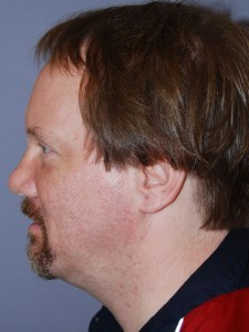 Eyelid Surgery With Nizar Merheb MD