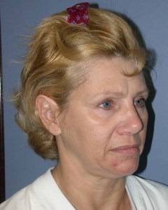 Facelift with Nizar MerhebMD