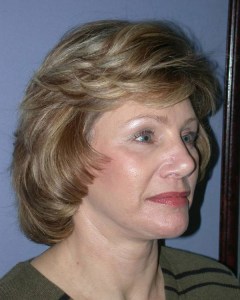 Facelift with Nizar MerhebMD