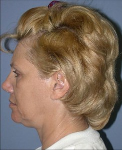 Facelift with Nizar MerhebMD