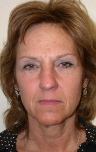 Facelift with Nizar MerhebMD