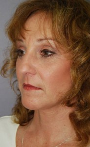 Facelift with Nizar MerhebMD