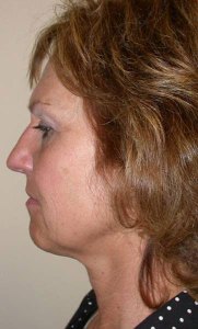 Facelift with Nizar MerhebMD