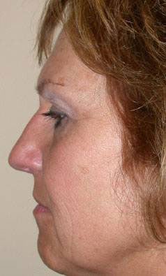 Facelift with Nizar MerhebMD