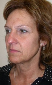 Total Facial Rejuvenation with Nizar Merheb MD