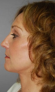 Total Facial Rejuvenation with Nizar Merheb MD