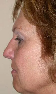 Total Facial Rejuvenation with Nizar Merheb MD