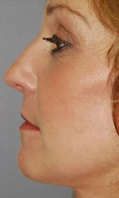 Total Facial Rejuvenation with Nizar Merheb MD