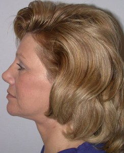 Total Facial Rejuvenation with Nizar Merheb MD