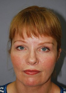 Total Facial Rejuvenation with Nizar Merheb MD
