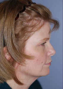 Total Facial Rejuvenation with Nizar Merheb MD