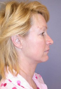 Total Facial Rejuvenation with Nizar Merheb MD