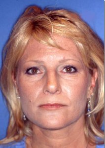 Total Facial Rejuvenation with Nizar Merheb MD