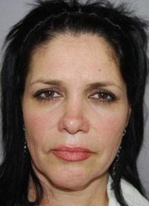 Laser Skin Resurfacing with Nizar Merheb MD