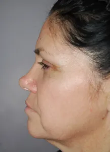 Laser Skin Resurfacing with Nizar Merheb MD