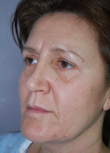 Laser Skin Resurfacing with Nizar Merheb MD