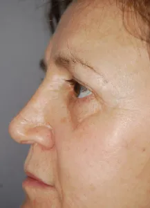 Laser Skin Resurfacing with Nizar Merheb MD