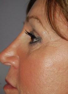 Laser Skin Resurfacing with Nizar Merheb MD