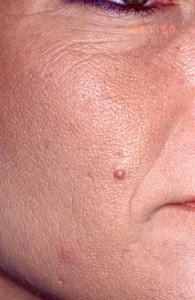Laser Skin Resurfacing with Nizar Merheb MD