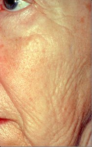 Laser Skin Resurfacing with Nizar Merheb MD