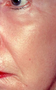 Laser Skin Resurfacing with Nizar Merheb MD