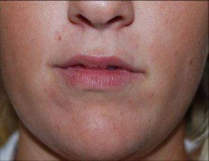 Lip Augmentation with Nizar Merheb MD