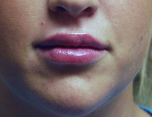 Lip Augmentation with Nizar Merheb MD