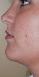 Lip Augmentation with Nizar Merheb MD