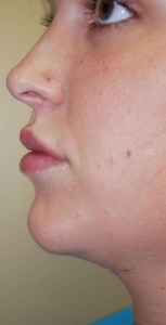 Lip Augmentation with Nizar Merheb MD