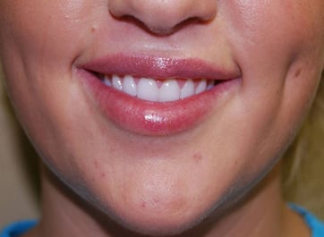 Lip Augmentation with Nizar Merheb MD