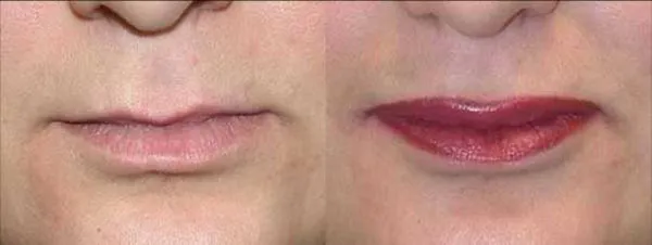 Lip Augmentation with Nizar Merheb MD