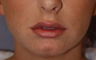 Lip Augmentation with Nizar Merheb MD