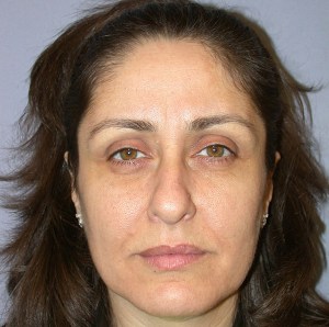 Lip Augmentation with Nizar Merheb MD