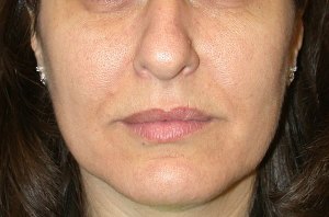 Lip Augmentation with Nizar Merheb MD