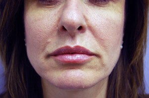 Lip Augmentation with Nizar Merheb MD
