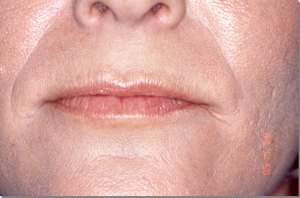 Lip Augmentation with Nizar Merheb MD