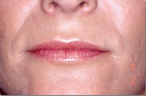 Lip Augmentation with Nizar Merheb MD