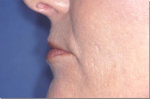 Lip Augmentation with Nizar Merheb MD
