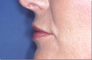 Lip Augmentation with Nizar Merheb MD