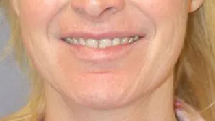 Lip Augmentation with Nizar Merheb MD