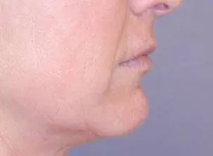 Lip Augmentation with Nizar Merheb MD