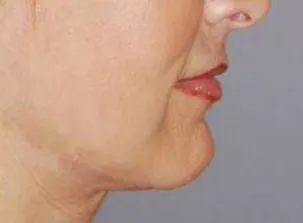 Lip Augmentation with Nizar Merheb MD