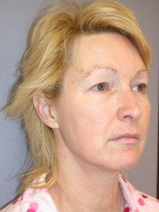 Midfacelift with Nizar Merheb MD